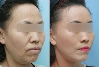 施爾美腹部抽脂：手術(shù)后保持效果長久嗎？