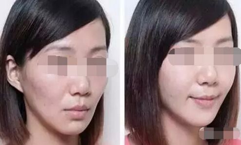 鼻骨矯正術后護理小貼士