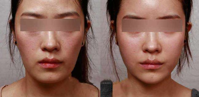 眼袋手術后效果持續(xù)多久？解析專家分享