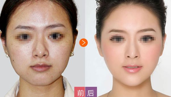 隆鼻手術(shù)后的修復期：經(jīng)驗分享
