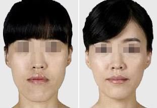 肋骨隆鼻后的面部消腫需要多長時間？消腫小竅門曝光！