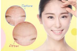 開內(nèi)眼角手術的疼痛程度如何？解析內(nèi)眼角手術的全貌