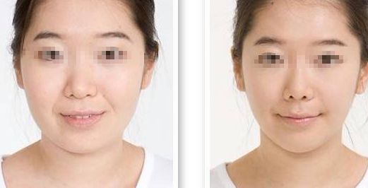 隆鼻手術失敗，修復需謹慎，風險不可忽視