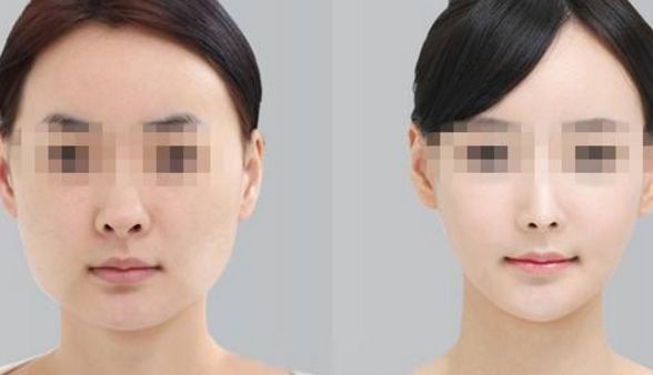 去眼袋手術后，會有疤痕嗎？術后眼部腫脹情況探析
