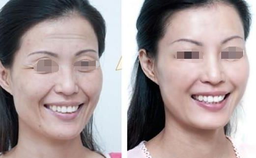 面部吸脂瘦臉效果如何？達到自然效果的關(guān)鍵是什么