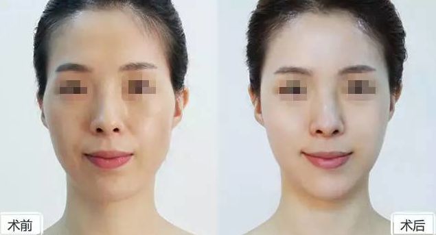 假體隆胸保持持久效果有多久？假體隆胸2個月后是否固定？