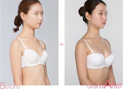 成都耳軟骨復(fù)合隆鼻手術(shù)：專家解析耳軟骨隆鼻效果及價(jià)格、術(shù)后護(hù)理