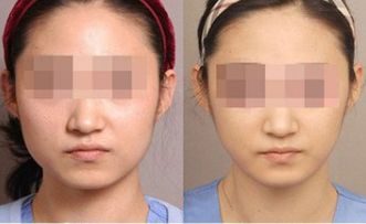 如何修復(fù)仁愛整形雙眼皮術(shù)后的眼部問題