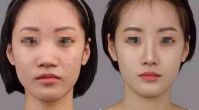 安全有效的處女膜修復(fù)手術(shù)異象：全面解析與經(jīng)驗分享