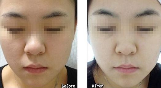 韓式微創(chuàng)無(wú)痕處女膜修復(fù)的效果如何？