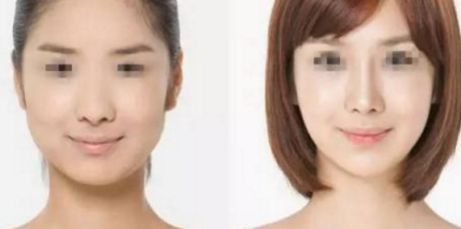 雙眼皮修復(fù)術(shù)最佳時機(jī)是什么時候？