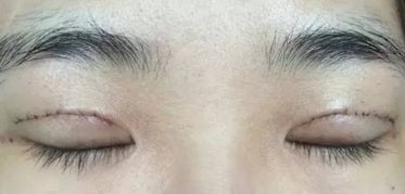 上海王會(huì)勇醫(yī)生鼻部整形案例分享：創(chuàng)新技術(shù)助您獲得完美鼻型！