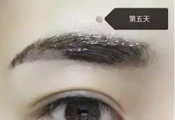 南昌美伊爾劉立軍醫(yī)生膨體隆鼻整形費(fèi)用？手術(shù)效果如何？帶您看醫(yī)生案例