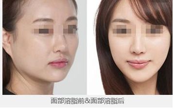 鄭州望京張鵬隆鼻2023年實力及成功案例公開，讓您放心無憂