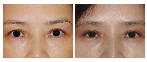 女生變成網(wǎng)紅臉需要多少投入？解析投資成本及效益