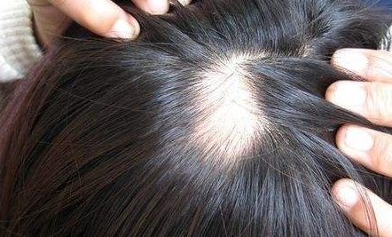 南京新生醫(yī)院植發(fā)效果如何？坐診專家簡(jiǎn)介、詳細(xì)地址一覽