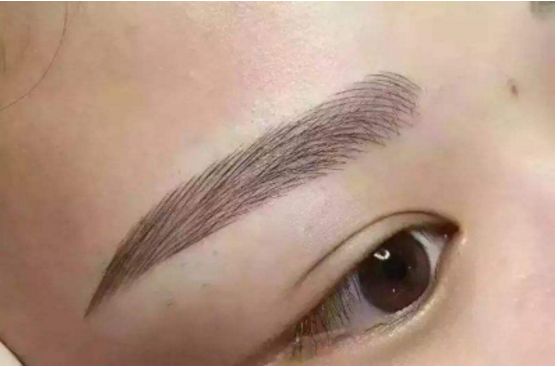 武漢葉子榮做拉皮的療效如何？專家醫(yī)生分享經(jīng)典案例