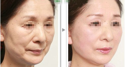 上海哪家磨骨醫(yī)院靠譜？華美、美聯(lián)臣、薇琳資歷雄厚值得信賴