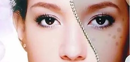 周一雄如何預(yù)約雙眼皮手術(shù)？案例分享與價(jià)格真實(shí)評(píng)估