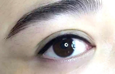 福州去眼袋去哪里效果好？哪家醫(yī)院專業(yè)可信？