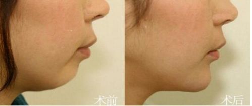 泉州最佳醫(yī)院推薦！一流技術(shù)與超高性價比，助您邁向完美美容整形！