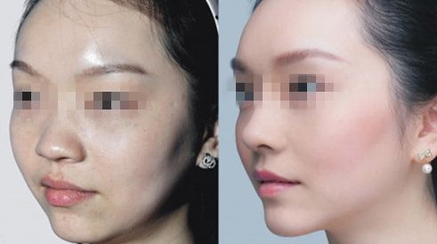 臺州哪家醫(yī)院治療乳頭矯正效果好？