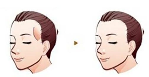 癌癥患者的雙眼皮手術(shù)費用分析及成功案例分享 癌癥患者的雙眼皮手術(shù)費用分析及成功案例分享