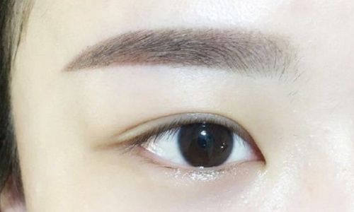 北京郭建玲雙眼皮手術(shù)費用是否昂貴？醫(yī)生案例分享全面解析