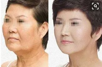 成都去痣名醫(yī)推薦，排行榜前五名有誰(shuí)？