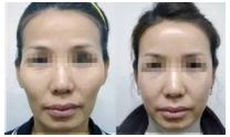重慶近視眼手術(shù)哪家醫(yī)院好？看看重慶佰視佳眼科醫(yī)院怎么樣