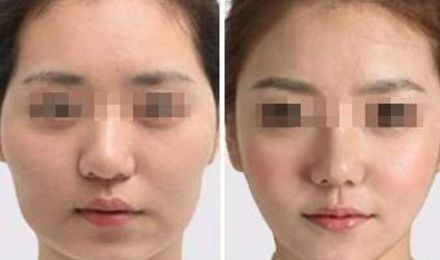 揭秘北京東方和諧脂肪填充真容，真實案例展示精湛技藝！