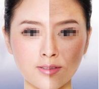 劉志剛醫(yī)生雙眼皮手術效果怎么樣？