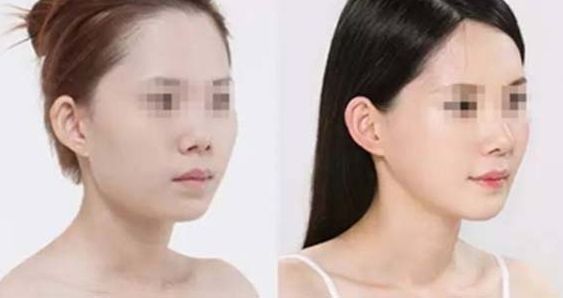 石家莊哪家整形醫(yī)院在隆鼻方面有口碑？