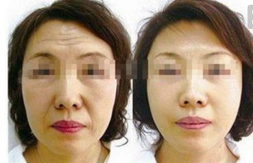 四川人民醫(yī)院王佳醫(yī)生提供下頜角整形案例，讓你輕松擁有小V臉