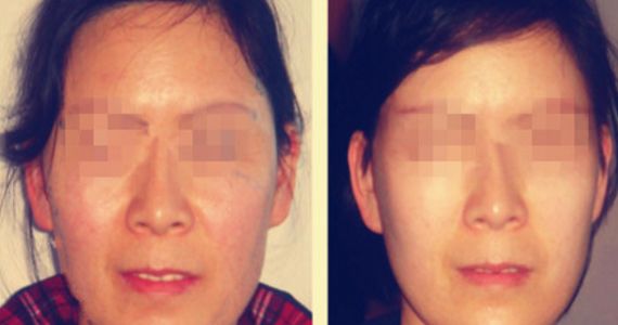 吉林地區(qū)哪家醫(yī)院的雙眼皮手術(shù)效果好 吉林地區(qū)哪家醫(yī)院的雙眼皮手術(shù)效果好