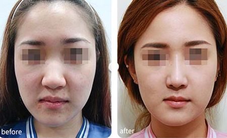 蘇州瘦身效果排名靠前的醫(yī)院推薦 蘇州瘦身效果排名靠前的醫(yī)院推薦
