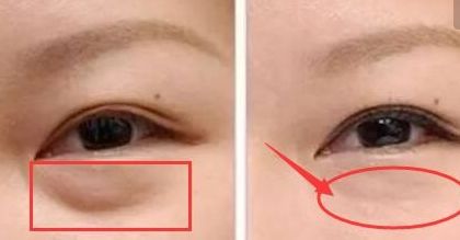 上海楊亞益雙眼皮修復技術(shù)解析，案例分享全文解讀