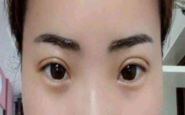 丁硯江填充脂肪的效果如何？為什么該方法備受推崇？