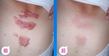 九院脂肪填充，醫(yī)生技術(shù)高超，詳細(xì)價(jià)格表揭曉