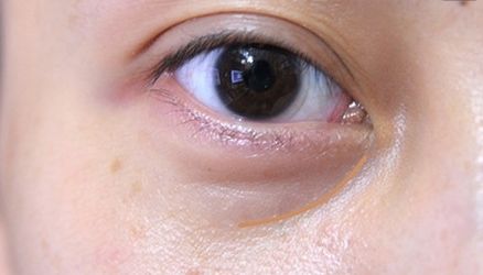【重慶】銅雀臺雙眼皮醫(yī)生技術(shù)對比，伍森林、王杰醫(yī)、梁海彬誰更厲害？