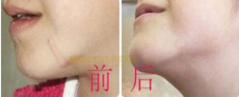 注射玻尿酸前需注意什么？用水清洗可否