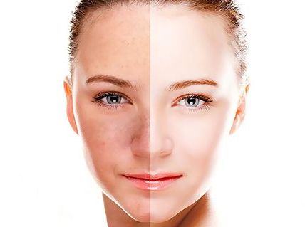 深圳米蘭柏羽整形醫(yī)院王志東醫(yī)生雙眼皮價格及成功案例分享 深圳米蘭柏羽整形醫(yī)院王志東醫(yī)生雙眼皮價格及成功案例分享