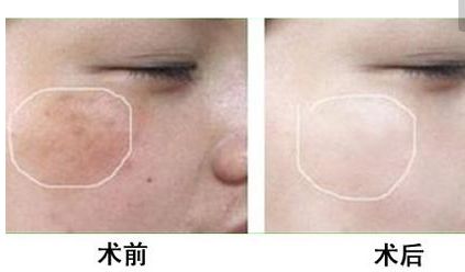 長沙美田芳斌雙眼皮讓你驚艷！令人難忘的改變來襲！