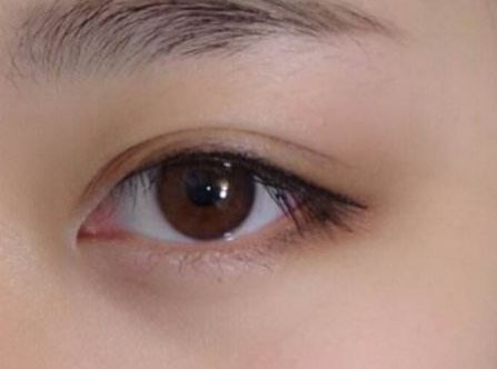 杭州任東做鼻部整容效果如何？MD技術(shù)解析真實(shí)案例分享！