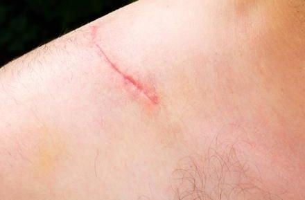 八大處張超面部吸脂效果解析：醫(yī)生技術(shù)實力、案例與價格