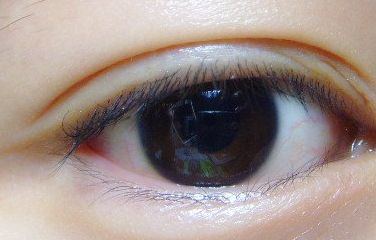 健麗整形醫(yī)院的去眼袋效果如何？2023患者分享案例！