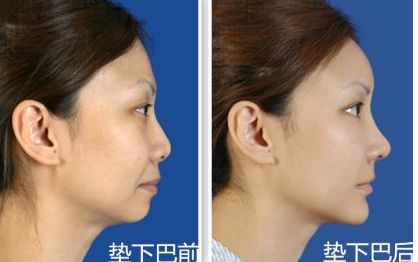上海九院鼻部整形手術專家李圣利，專業(yè)水準如何？