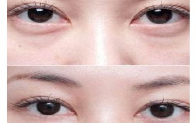 北京張笑天的下頜角手術技術及豐碩成果曝光！醫(yī)術精湛，案例展示震撼人心