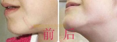 上海哪家醫(yī)院有專業(yè)的唇裂手術(shù)醫(yī)生？治療兔唇患者的必備信息！