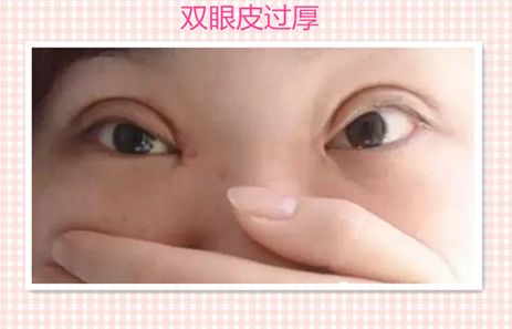 鄭州東方整形醫(yī)院大腿吸脂術(shù):醫(yī)生解讀及成功案例分享 鄭州東方整形醫(yī)院大腿吸脂術(shù):醫(yī)生解讀及成功案例分享